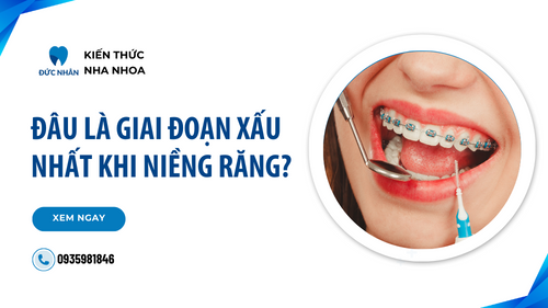 Đâu là giai đoạn xấu nhất khi niềng răng và mẹo cải thiện nhan sắc?